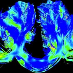Corpus callosum, left-right connections, in a Parkinson's brain